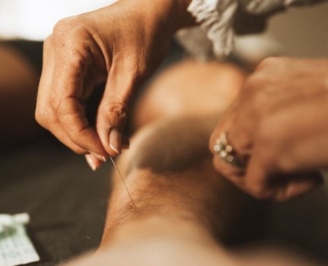 Acupunctuur behandeling van de arm bij acupunctuurpraktijk De Haere in Doornspijk